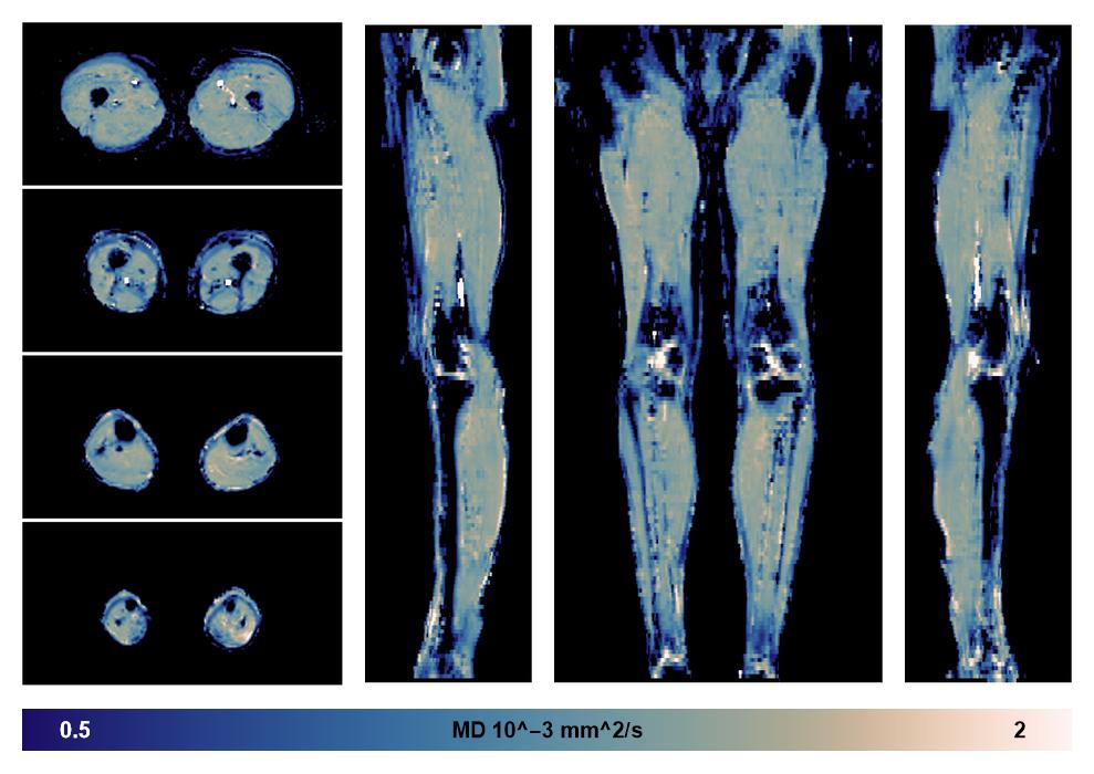 IVIM corrected whole leg muscle mean diffusivity obtained from diffusion tensor imaging.